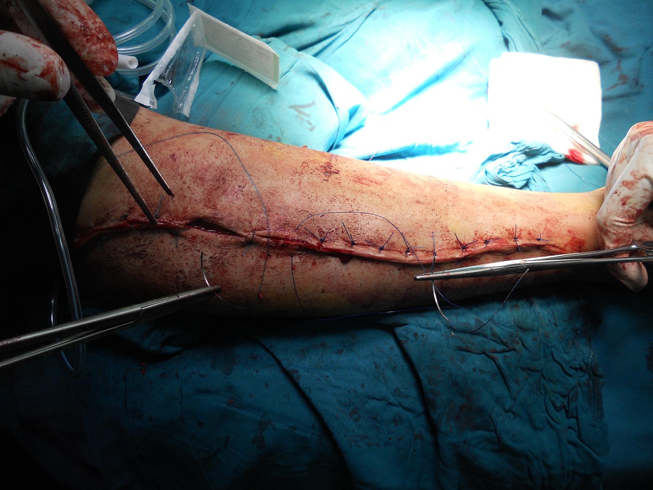 Finding the Best Louisiana Orthopedic Surgeons: A Comprehensive Guide